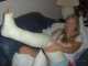 Stacia and her broken leg